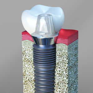 Dental-Implants