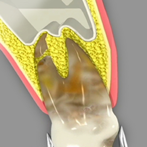 Wisdom Teeth Extractions